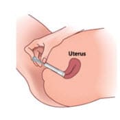 تزریق ژل ژل تنگ کننده واژن دائمی بانوان آکائو (1 جعبه)